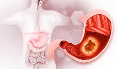 위암 3기 생존율