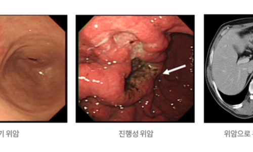 위암 이미지