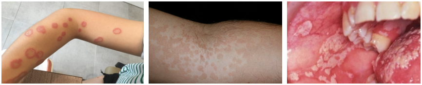 피부가 갑자기 가렵다? 피부 곰팡이균이 주범이다!