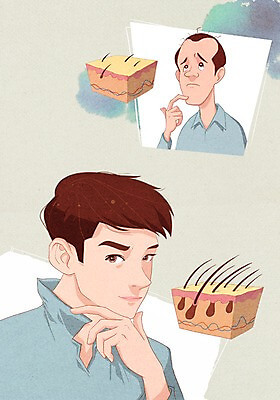 모발이식 부위별 비용