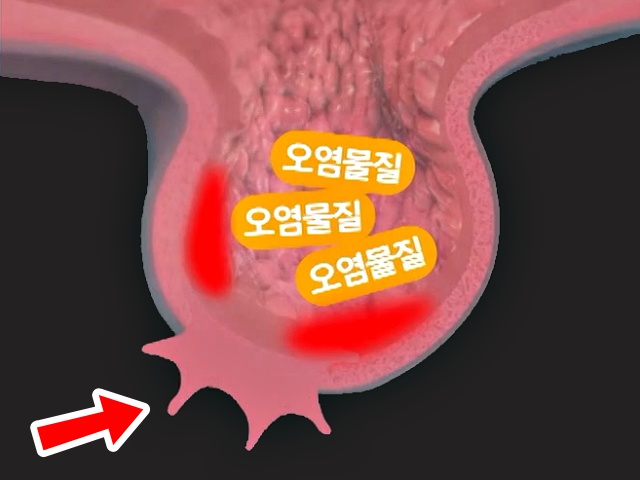 장천공, 장에 독소가 쌓이면, 장독소배출방법 장독소자가진단, 장게실염 대장암, 건강 팁줌 매일꿀정보