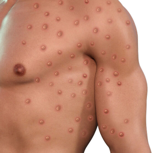 수포 발진이 난 남자 몸