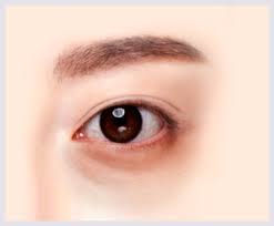 눈밑지방재배치