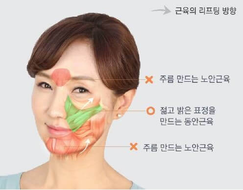 근육의 리프팅 방향