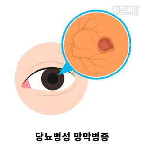 당뇨병 초기증상