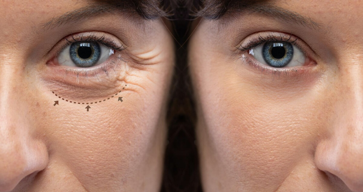 눈밑떨림으로-인한-근육-경련-표시