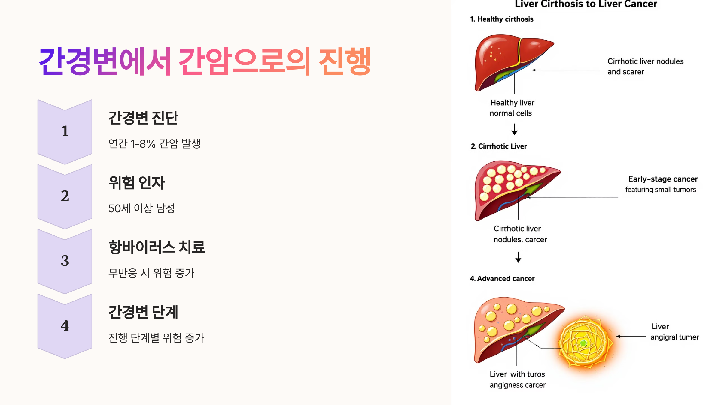 간경변에서 간암으로의 진행