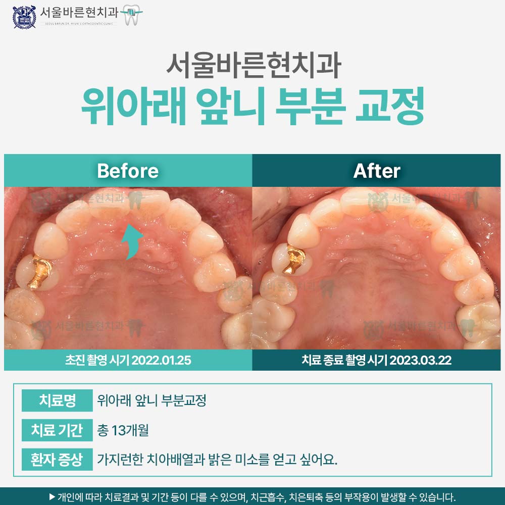 해운대치아교정