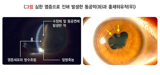 포도막염