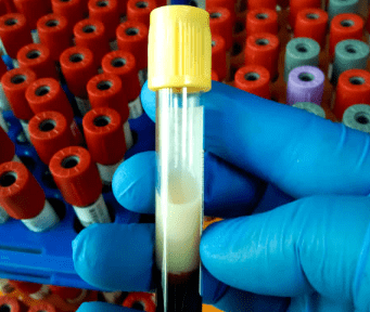 중성지방 낮추는 방법&amp;#44; 중성지방 정상수치