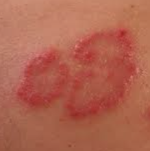 백혈구 수치가 낮은 이유 25