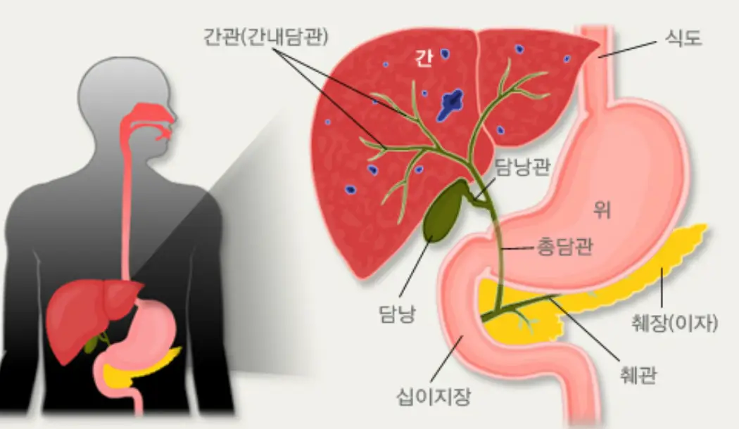 담석증