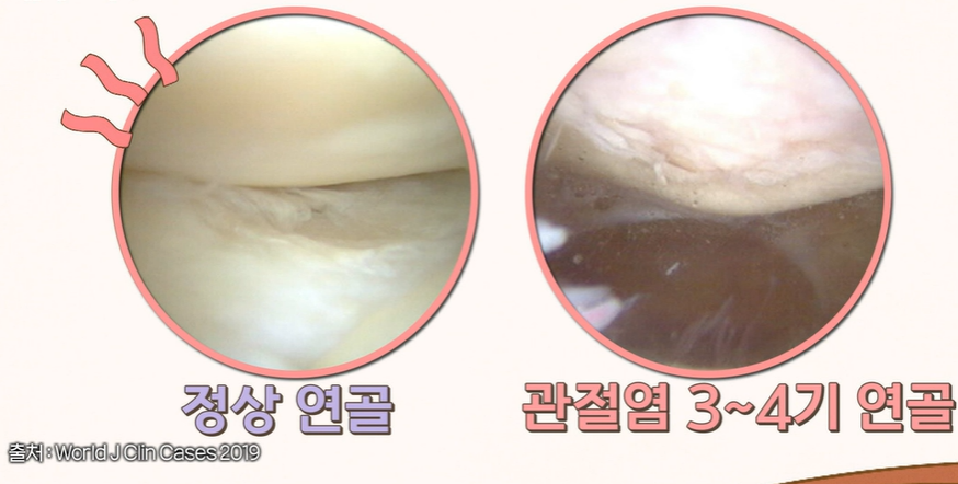 콘드로이친 효능
