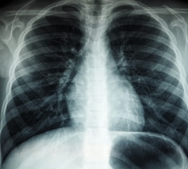 림프절염 증상, 원인, 급성, 결핵성 (목 사타구니 서혜부 겨드랑이)