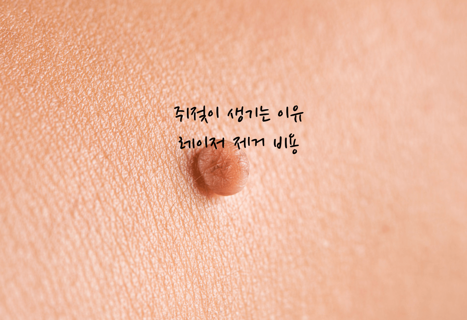 쥐젖이 생기는 이유
