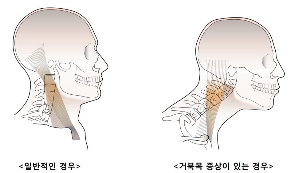 거북목 