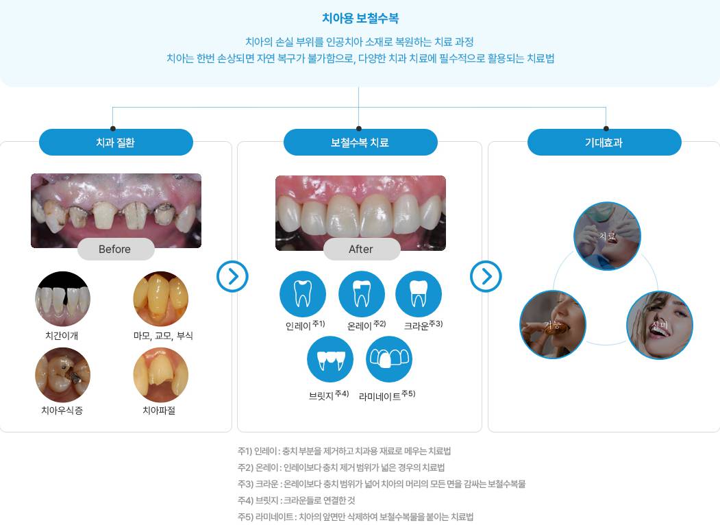 하스 치아용 보철수복