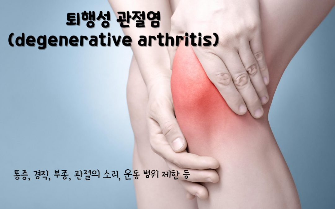 퇴행성 관절염(degenerative arthritis)
골관절염(Osteoarthritis)
퇴행성 관절염의 주요 증상 : 통증, 경직, 부종, 관절의 소리, 운동 범위 제한 등