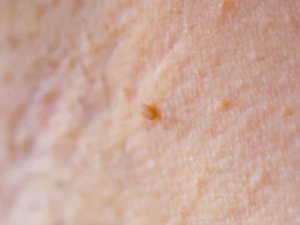 쥐젖이 생기는 이유&amp;#44; 쥐젖 제거방법