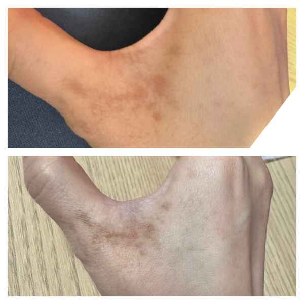 동남아 여행 후 손등 반점_ 식물성광피부염