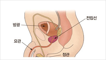 전립선암 증상,전립선암초기증상 및 전립선암에 좋은 음식,전립선에 좋은 음식