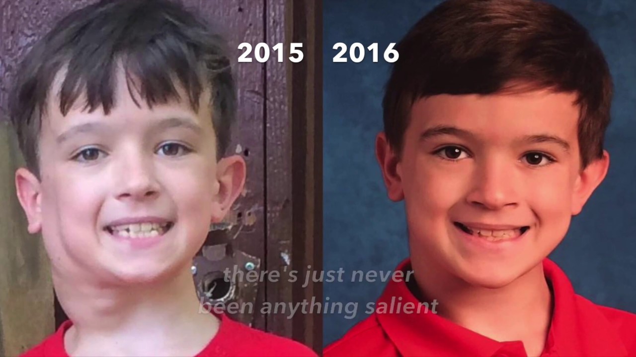 신경섬유종 환자아이가 1년뒤 치료완료된 모습