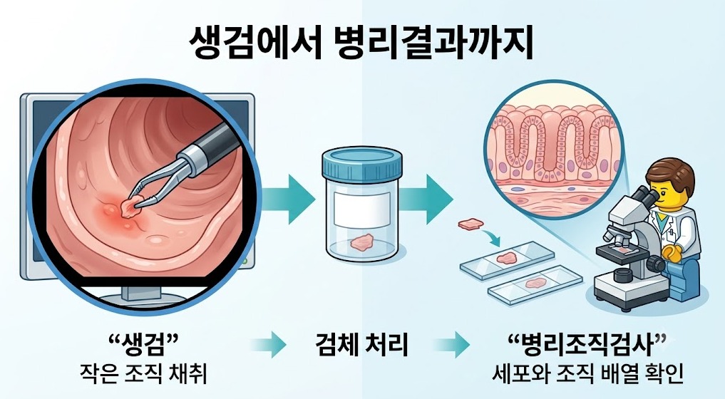 대장 점막에서의 작은 조직 채취(생검)부터 검체 용기 이동, 현미경을 통한 병리조직검사까지의 흐름을 보여주는 인포그래픽