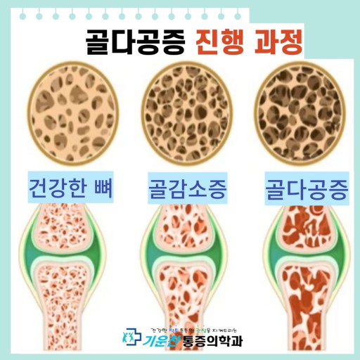 골다공증