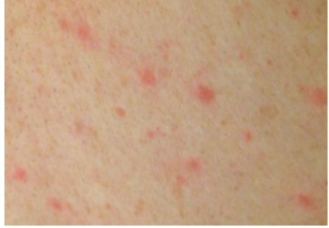 장티푸스-장미진