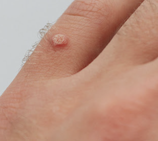 사마귀 제거방법 5