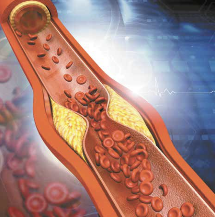 콜레스테롤 수치 이상