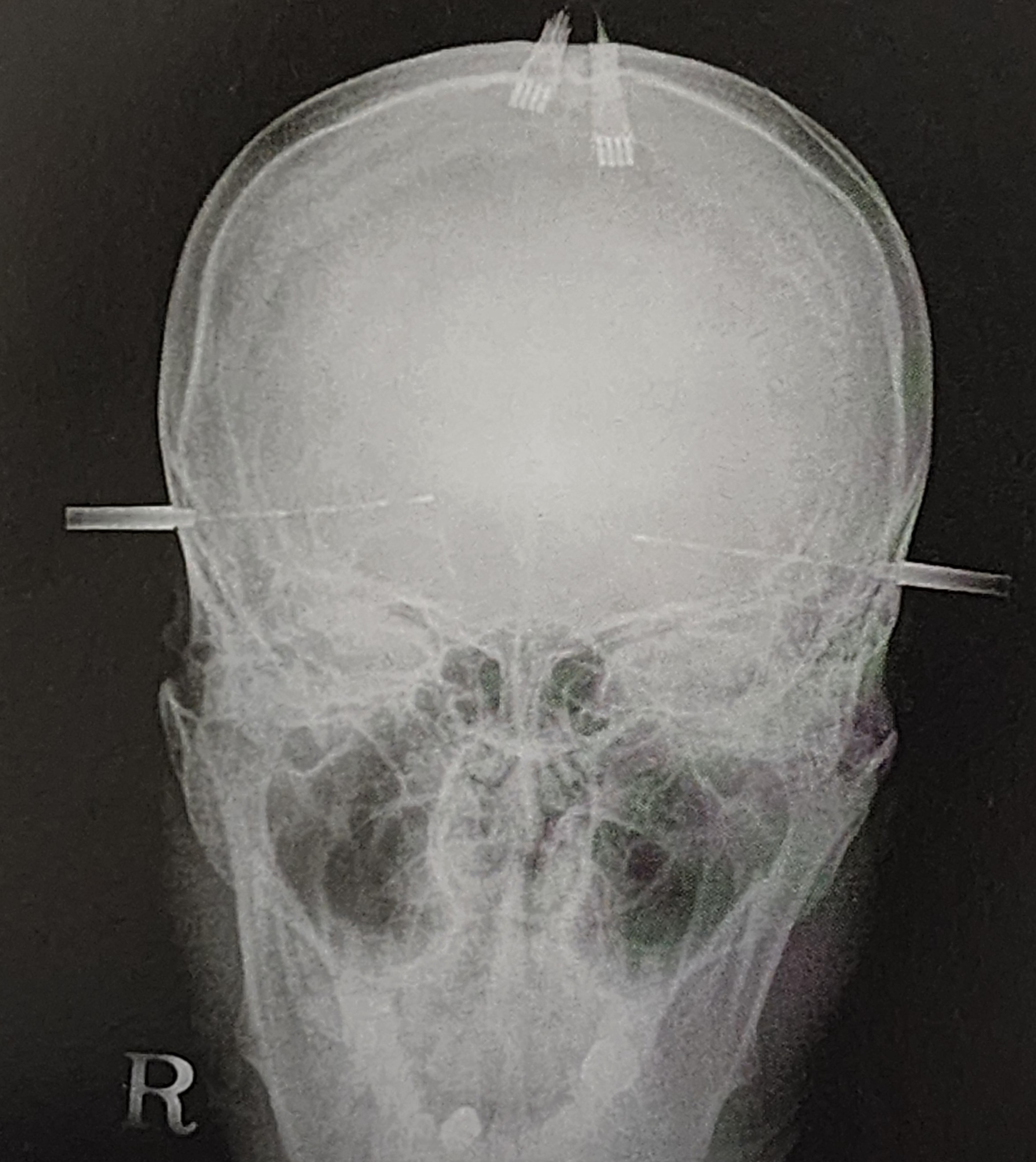 뇌전증 수술 전 검사