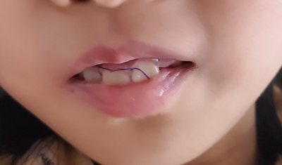 아이 과잉치수술 후 입안