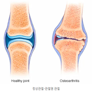 정상관절 관절염 관절