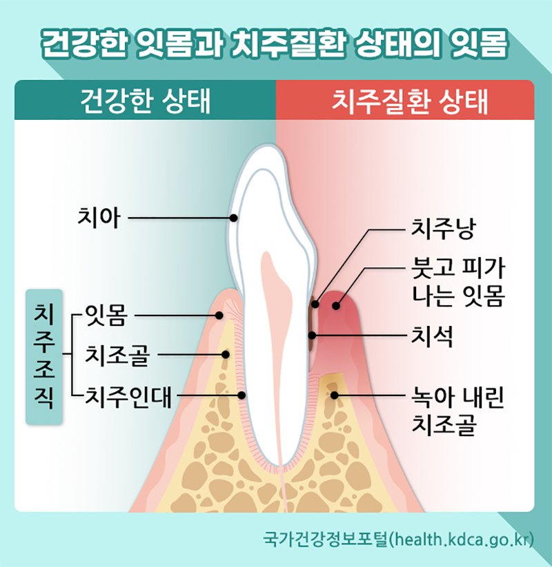건강한 잇몸과 치추질환 상태 잇몸