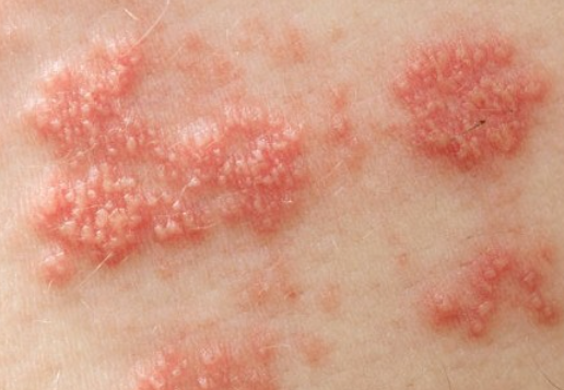 대상포진의 증상