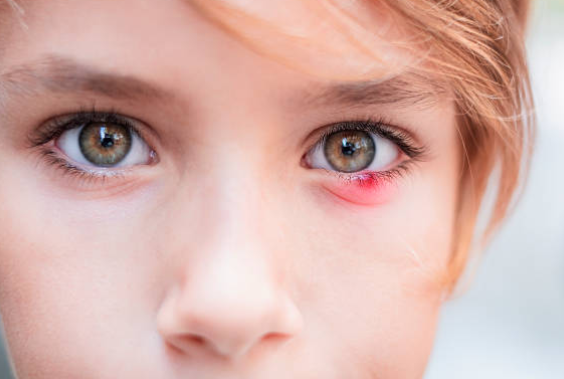 아기 건강 정보 다래끼 증상 (겉다래끼 속다래끼 콩다래끼) 원인 치료법