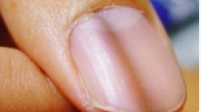 손톱 세로줄 관련된 사진1