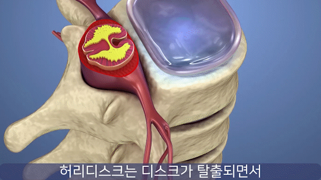 허리디스크 원인