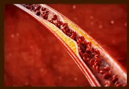 콜레스테롤 개선