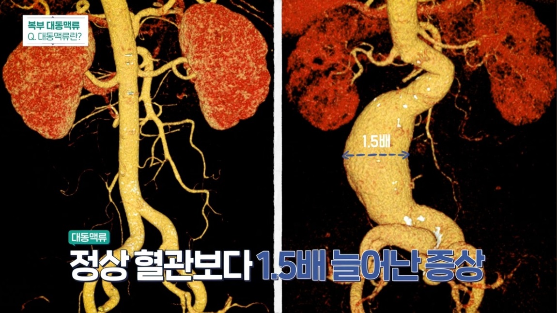 명의-복부-대동맥-강진모-교수