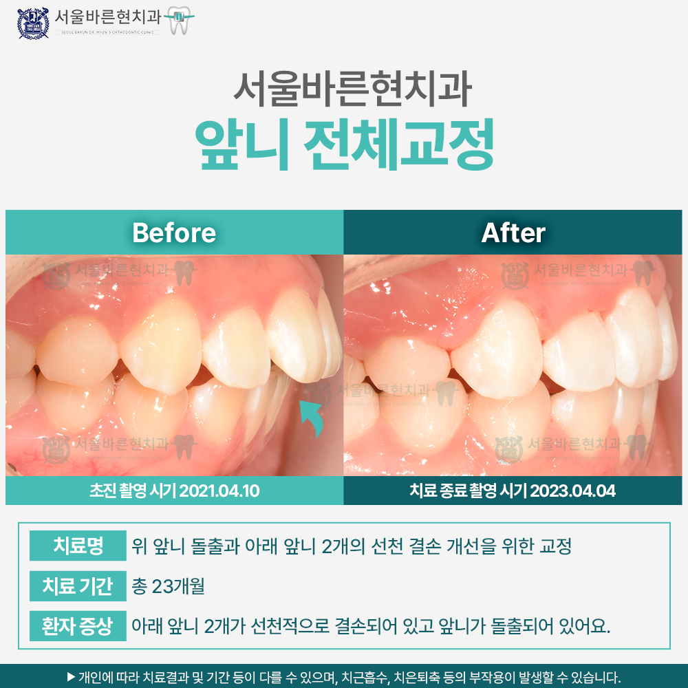 부산앞니교정
