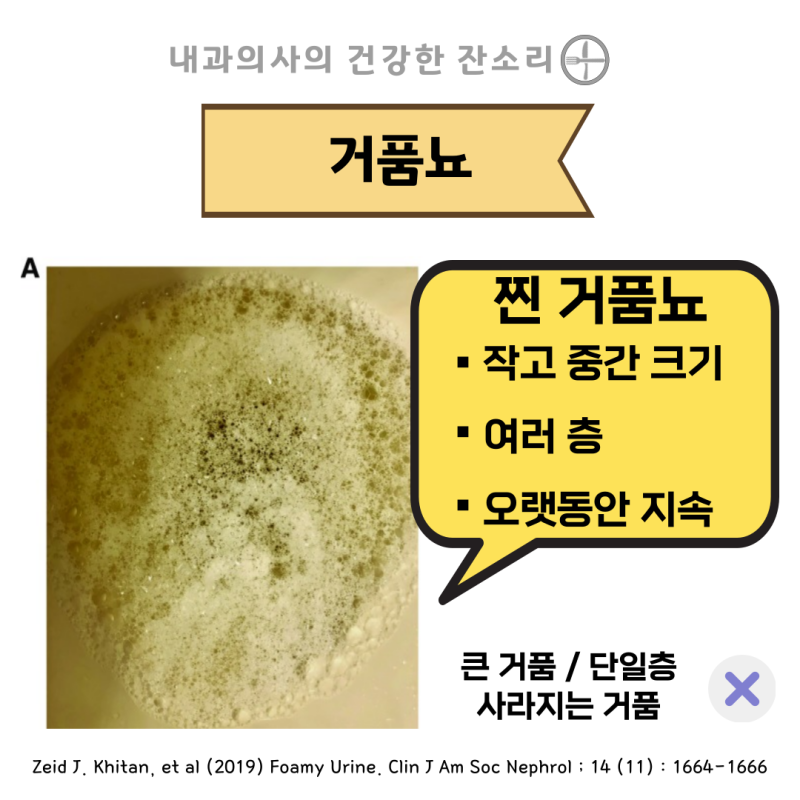 소변에 거품이 나는 이유 증상 해결책