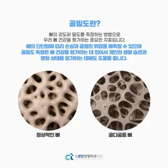 골밀도 검사 수치 골밀도 높이는 방법 간단 정리_12