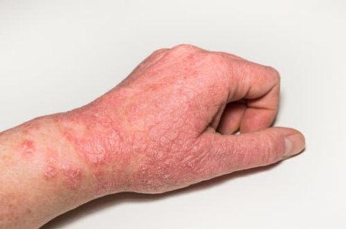 손 습진 &amp; 접촉성 피부염 &ndash; 원인부터 관리까지 완전 정리