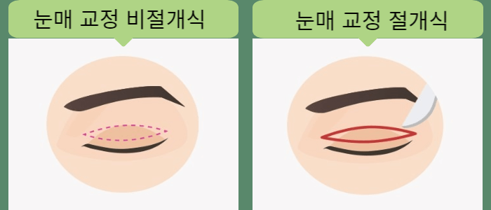 눈매 교정