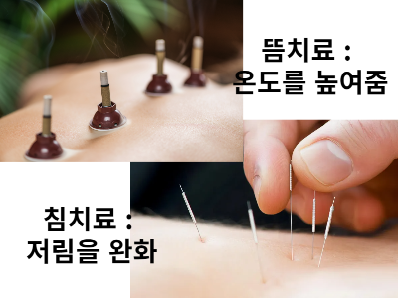 뜸 치료, 침 치료 이미지
