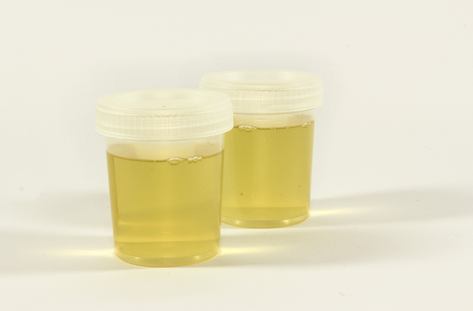 소변 컵에 담긴 소변