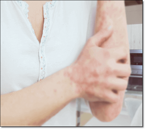 아토피 피부염 남성