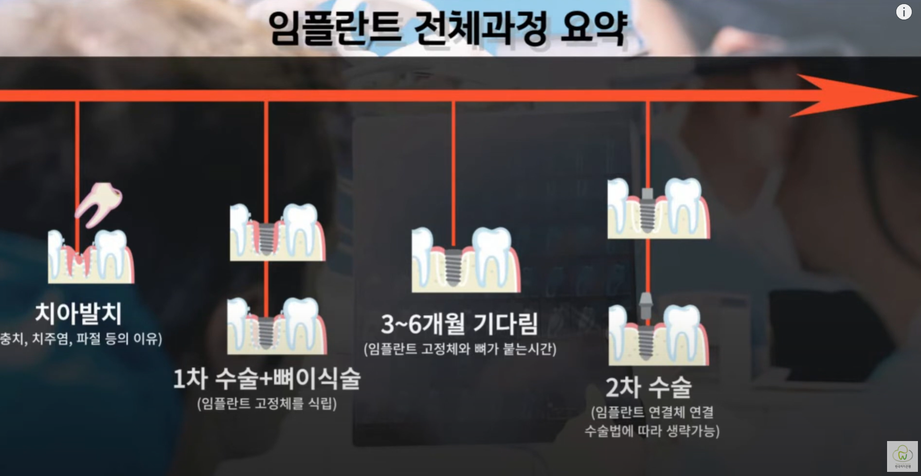 임플란트 전체과정 요약